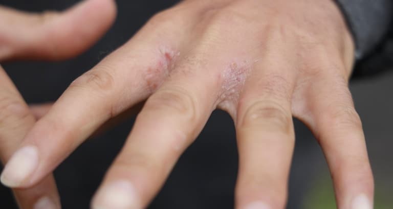 2022-11-04T17:32:52.659Z-SCABIES111.jpg