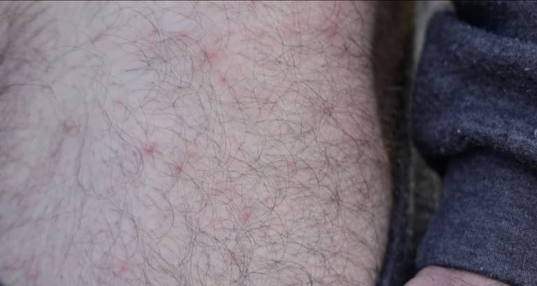 2022-11-04T17:28:29.088Z-scabies%20111ibrahim.jpg