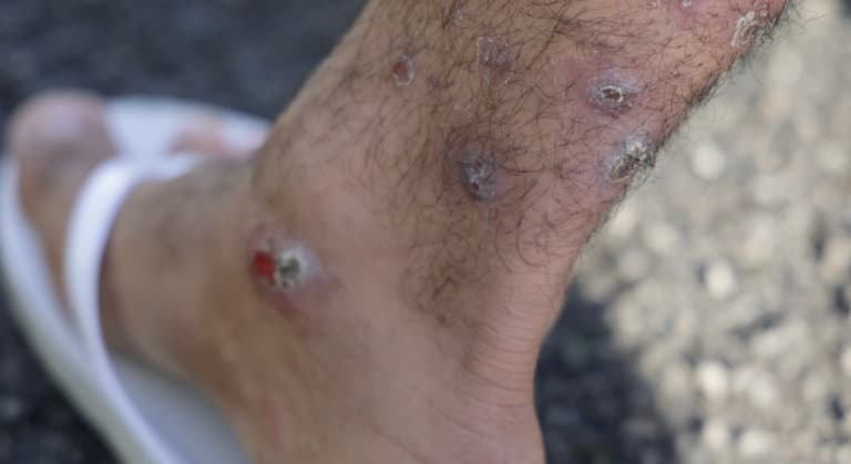 2022-11-04T17:33:11.509Z-scabies12.jpg